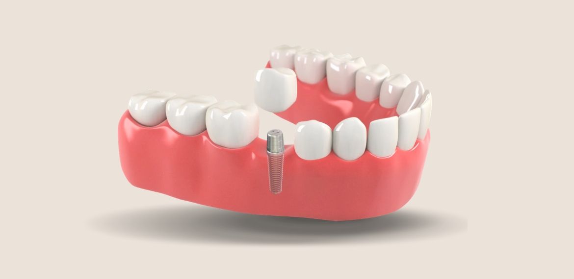 Banner - Implant Restorations