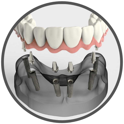 Customized Crown Support