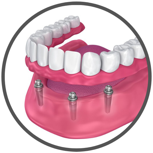 Hybrid Prosthesis