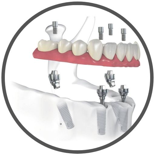 Screw Retained Implant